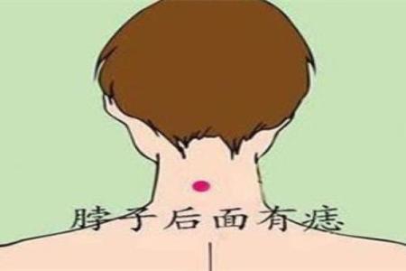 脖子上不同位置胎记算命