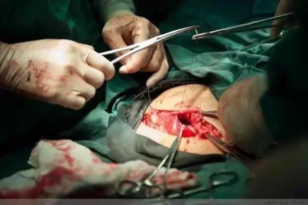 剖腹产八字准吗