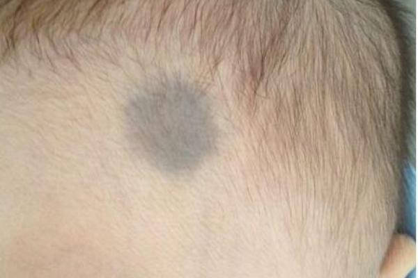 额头胎记算命 额头胎记算命