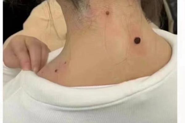 女人背部痣相图解算命