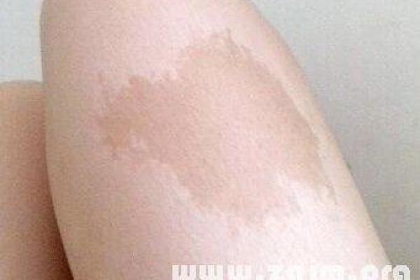 胎记释义，胎记算命中代表什么