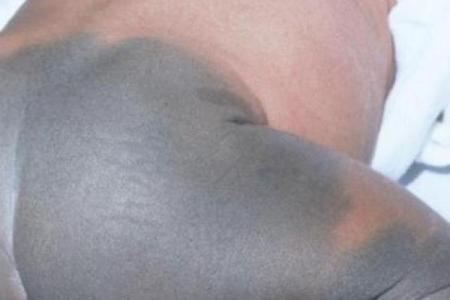 胎记释义，胎记算命中代表什么