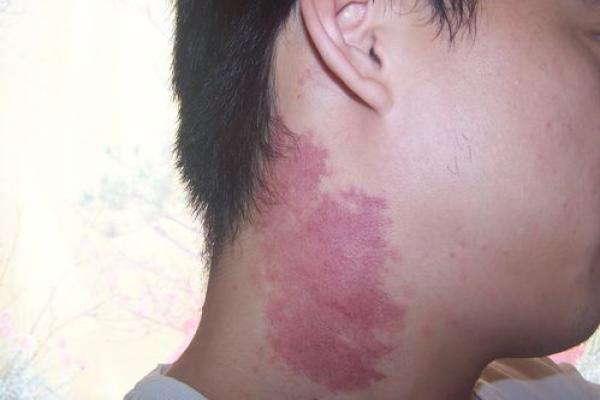 腰部上的胎记如何算命分析? 腰部上的胎记如何算命分析?