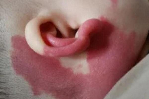 红胎记算命图解 红胎记算命图解