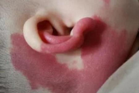 红胎记算命图解