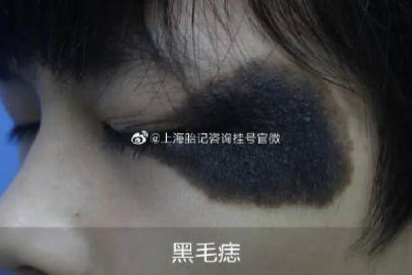 黑色胎记算命分析