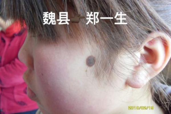 黑色胎记算命分析