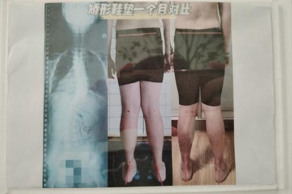 内八字、外八字孩子脚型正常不正常，家长可以这么判断