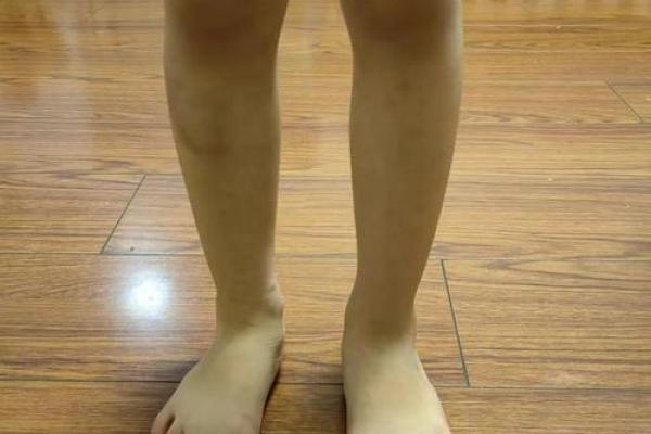 内八字腿型 内八字腿型