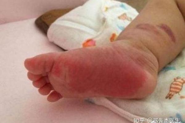 脚底的胎记算命分析 脚底的胎记算命分析