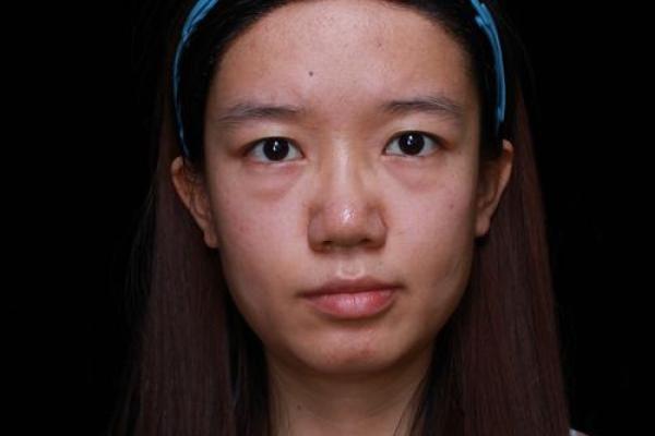 八字眼袋 八字眼袋