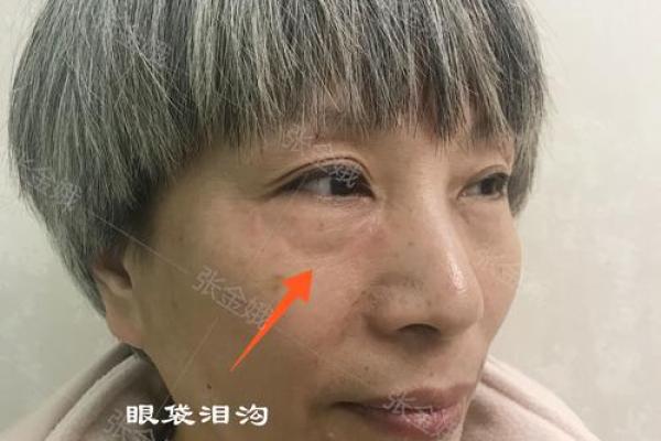 八字眼袋 八字眼袋