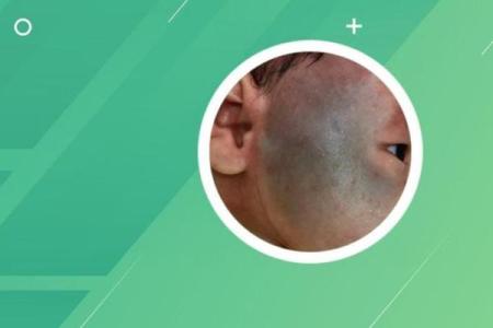 不同部位的胎记算命分析