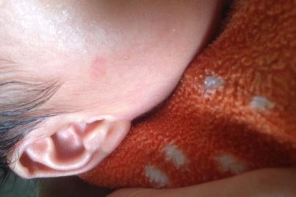 红色胎记算命看危害 红色胎记算命看危害