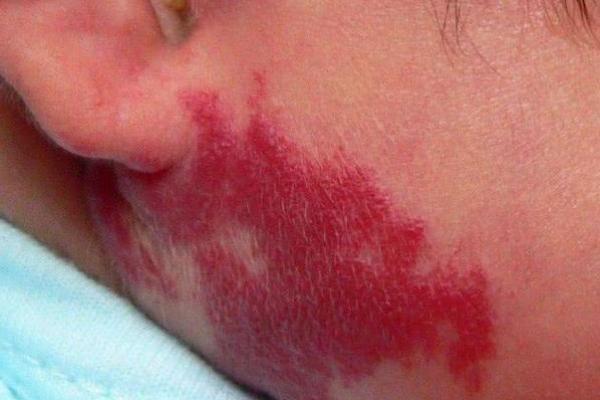 红色胎记算命看危害 红色胎记算命看危害