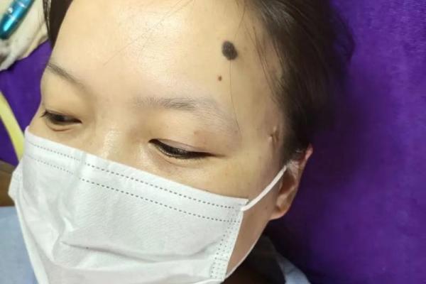 额头长胎记算命一生 额头长胎记算命一生