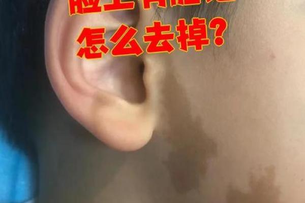 额头上的胎记算命 额头上的胎记算命