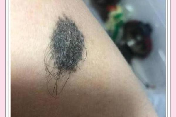 额头上的胎记算命 额头上的胎记算命