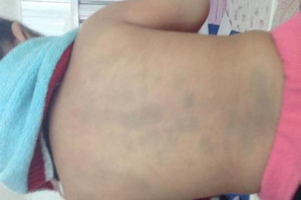 全面解析:胎记算命图解 全面解析:胎记算命图解