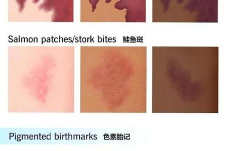 胎记算命图解：什么是红胎记？