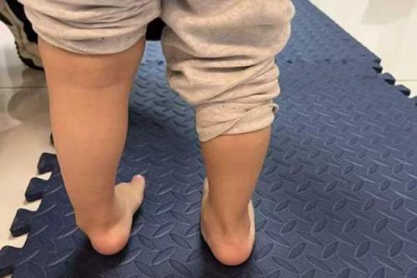 2岁八字脚 2岁八字脚