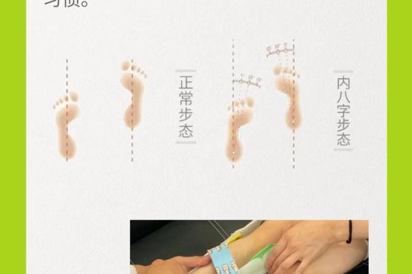 纠正外八字脚 纠正外八字脚