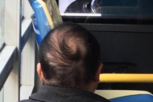 后脑勺有三条竖杠 后脑勺头皮三条竖纹算命 后脑勺有三条竖杠 后脑勺头皮三条竖纹算命