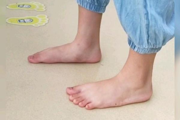 内八字原来有这么多伤害！吓得我赶紧比直脚走路