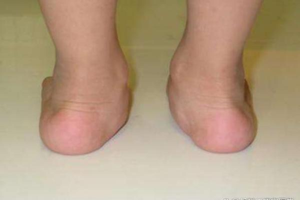 足脊健康知识小课堂(第三期) - 外八字篇 足脊健康知识小课堂(第三期) - 外八字篇