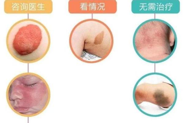 胎记算命：从胎记看运势